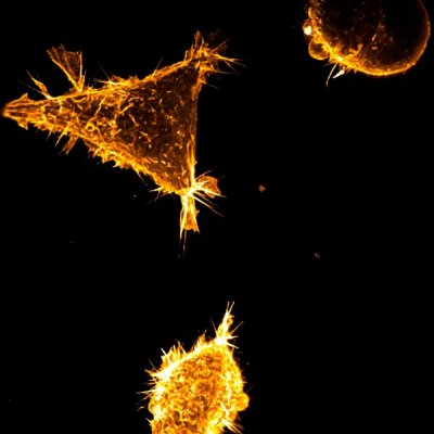 Yellow cancer cells